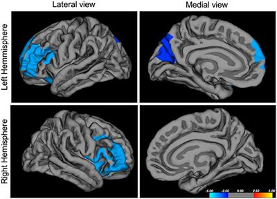 Irritability Is Associated With Decreased Cortical Surface Area and Anxiety With Decreased Gyrification During Brain Development